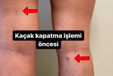 Kaçak Kapatma Tedavisi